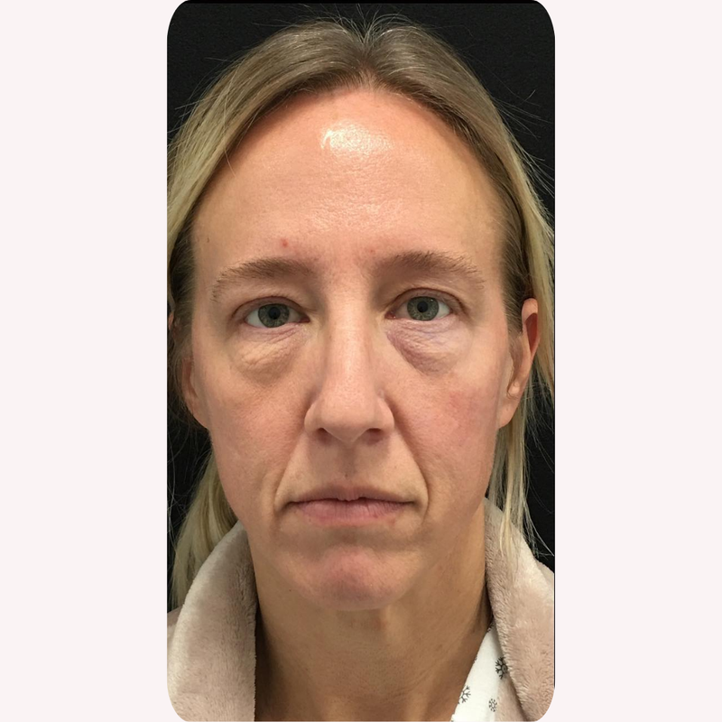 Caroline T. before using Miyora, 55 · 4 sessions in