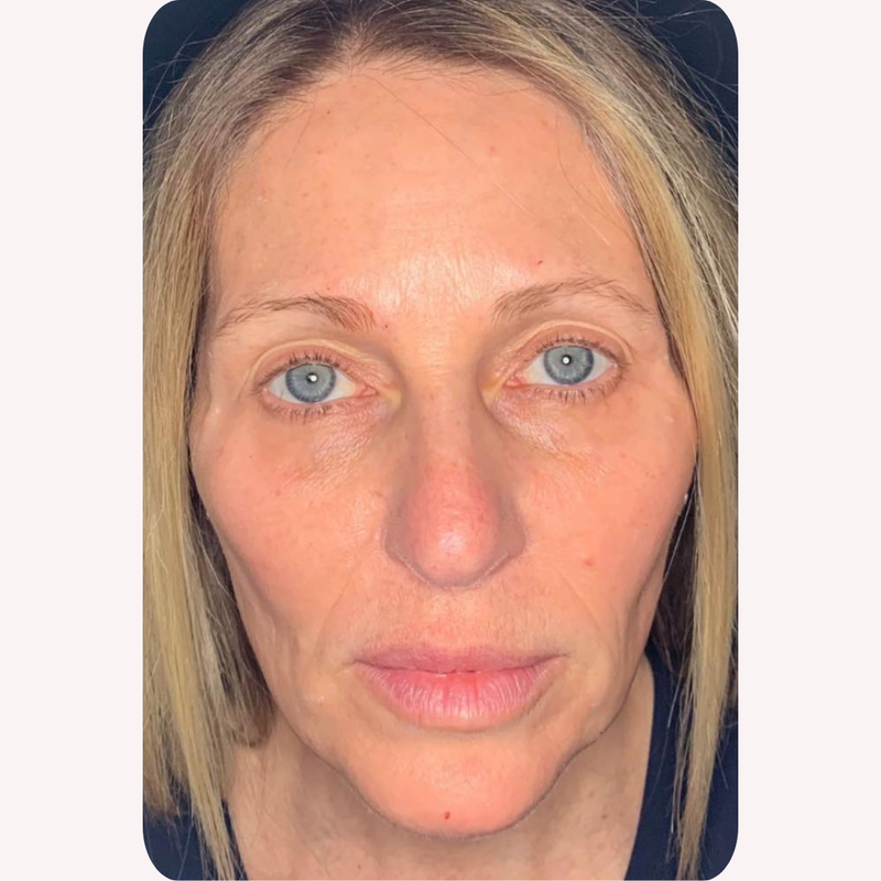 Karen D. before using Miyora, 50 · 4 months in