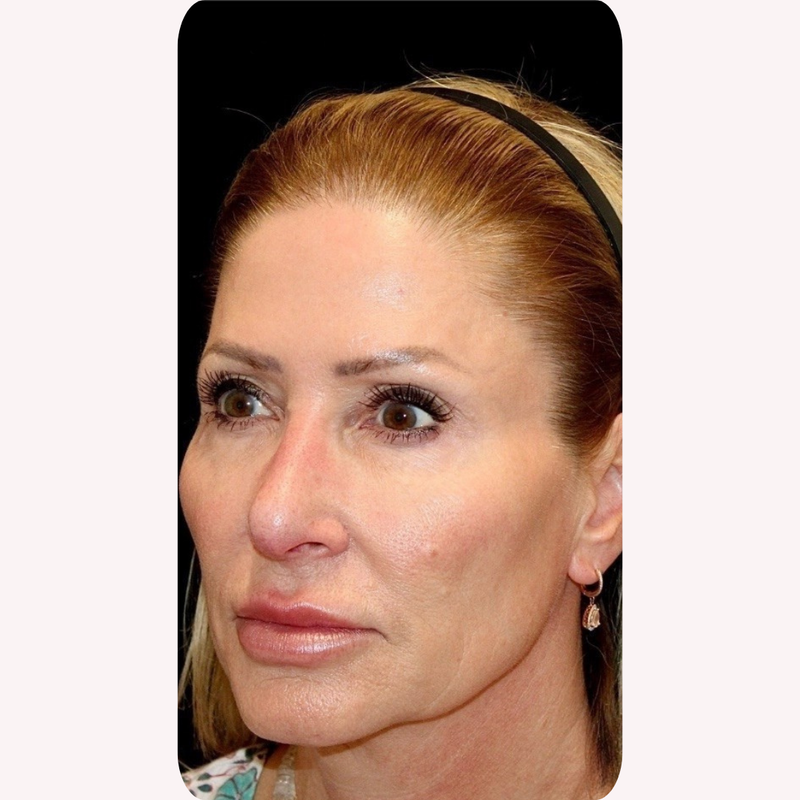 Beth K. before using Miyora, 60 · 19 weeks in